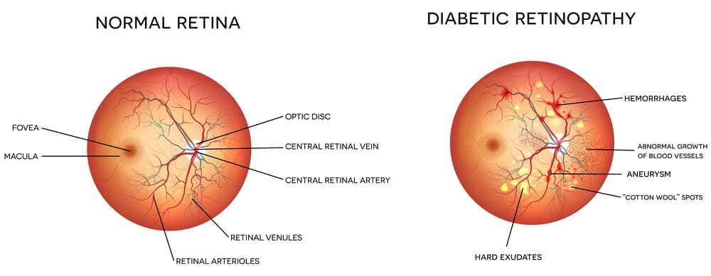 Diabetic Eye